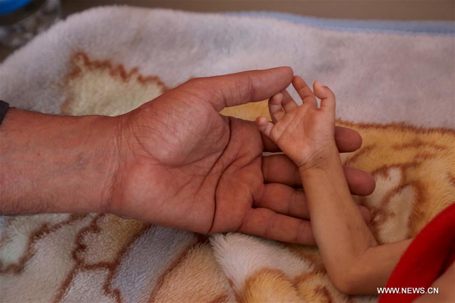 الصورة : تفشي سوء التغذية بين أطفال اليمن 