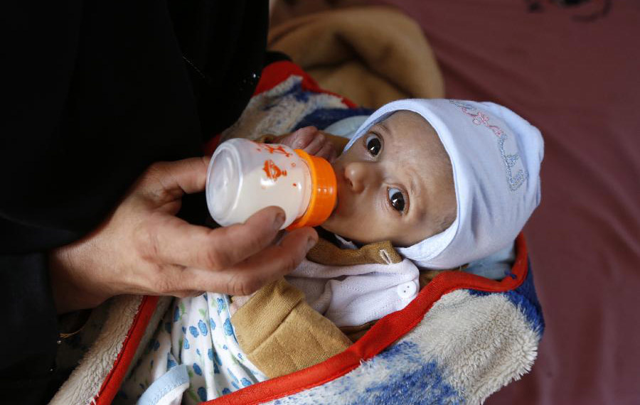 معاناة أطفال اليمن من سوء التغذية